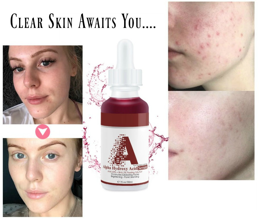 AHA 30% BHA 2% Exfoliating Facial Peel - MQO 100 pcs