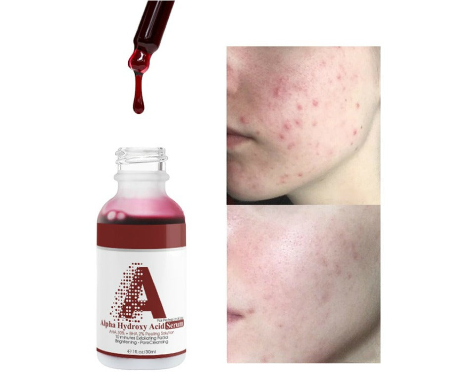 AHA 30% BHA 2% Exfoliating Facial Peel - MQO 100 pcs